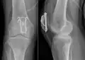 Erweiterte Zuggurtungs-osteosynthese einer Patella-Querfraktur mit axialen Bohrdrähten