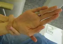 Handgelenkzeichen beim Marfan-Syndrom